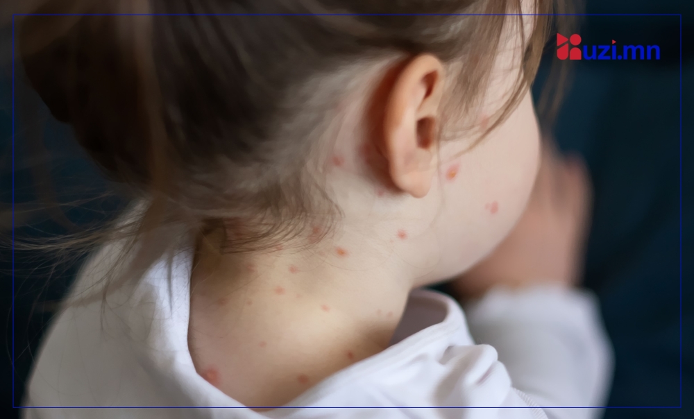 ХӨСҮТ: Улаанбурхан өвчний батлагдсан тохиолдол 23 нэмэгджээ