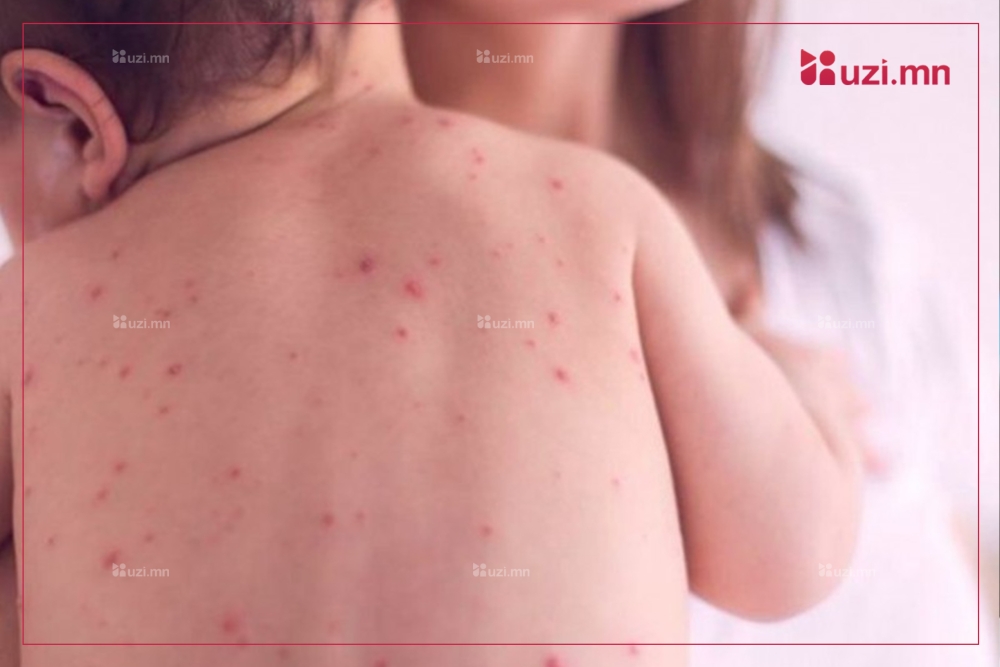 ХӨСҮТ: Улаанбурхан өвчний батлагдсан тохиолдол 25 нэмэгджээ