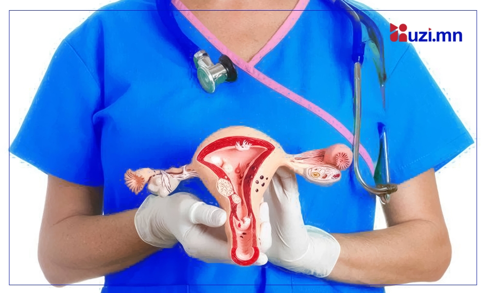 Монгол Улсад умайн хүзүүний хорт хавдрын өвчлөл өндөр хэвээр байна